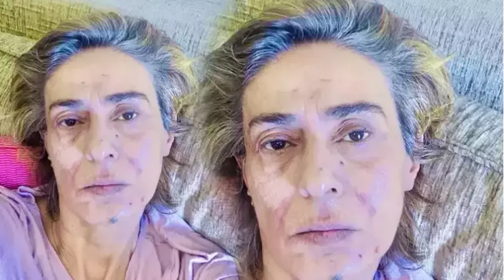 Yıldız Tilbe’nin Yüzüne Ne Oldu Son Paylaşımı Sevenlerini Endişelendirdi (1)